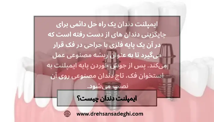 ایمپلنت دندان