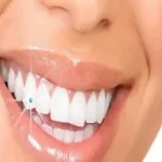 ترمیم لمینت دندان