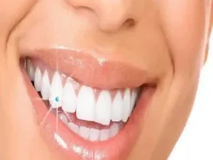 ترمیم لمینت دندان