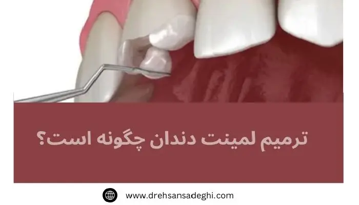 ترمیم لمینت دندان 