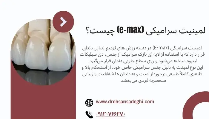 لمینیت سرامیکی (e-max)