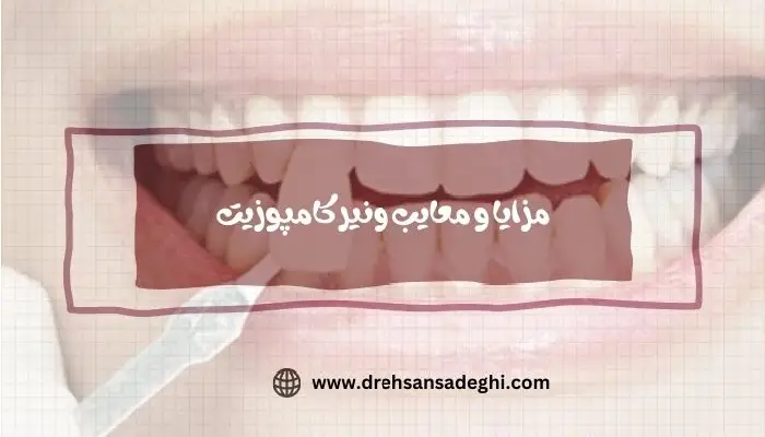 کامپوزیت ونیر