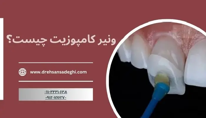 کامپوزیت ونیر
