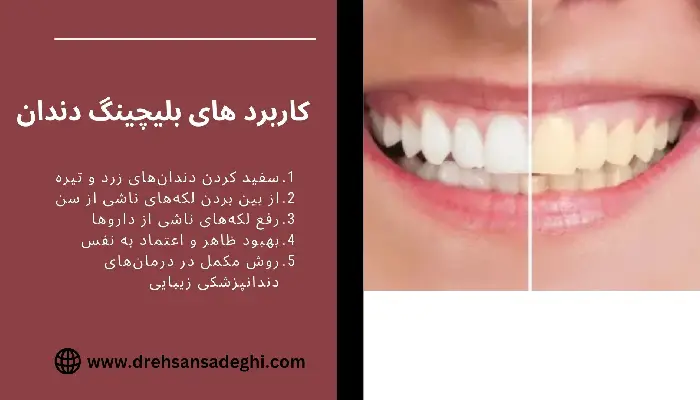 بلیچینگ دندان