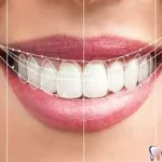 تفاوت لمینت و کامپوزیت