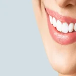 سفید کردن کامپوزیت