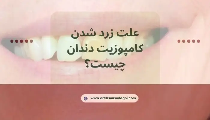 زرد شدن کامپوزیت دندان