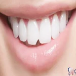 مراقبت های بعد از کامپوزیت