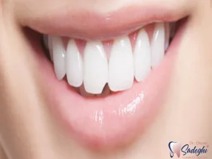 مراقبت های بعد از کامپوزیت