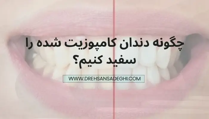 سفید کردن کامپوزیت دندان