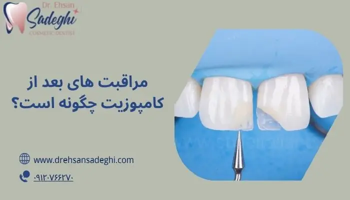 مراقبت های بعد از کامپوزیت