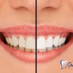 تغییر رنگ لمینت دندان