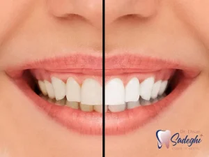 تغییر رنگ لمینت دندان
