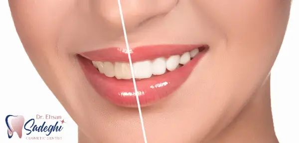 تغییر رنگ لمینت دندان