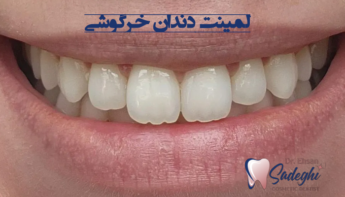 لمینت دندان خرگوشی چیست
