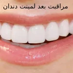 مراقبت بعد لمینت دندان