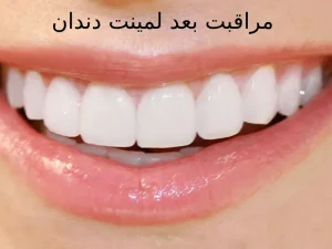 مراقبت بعد لمینت دندان