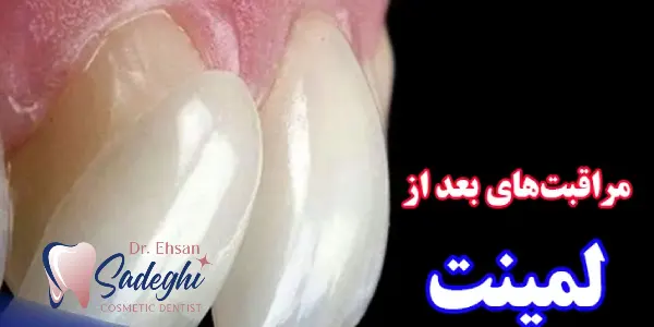 مراقبت‌های بعد از لمینت دندان