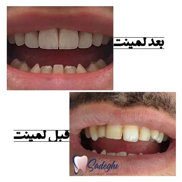 نمونه کار لمینت دندان توسط دکتر احسان صادقی