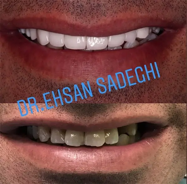 نمونه کار لمینت دکتر احسان صادقی