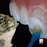 هزینه لمینت دندان