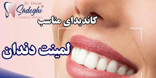 کاندیدای مناسب برای لمینت دندان