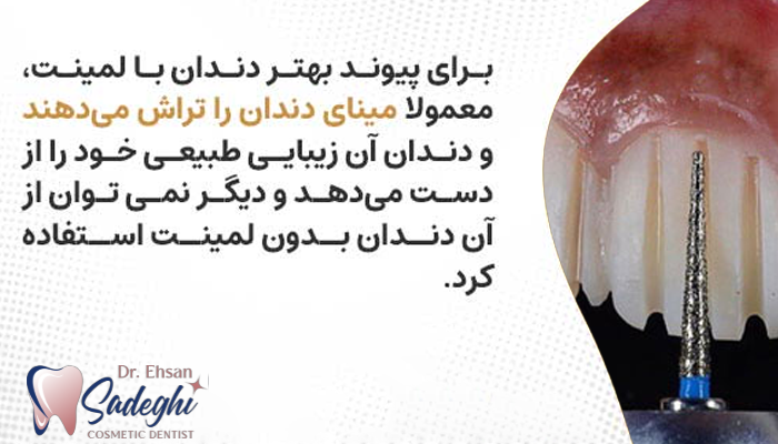 تراشیدن مینا از عوارض لمینت دندان