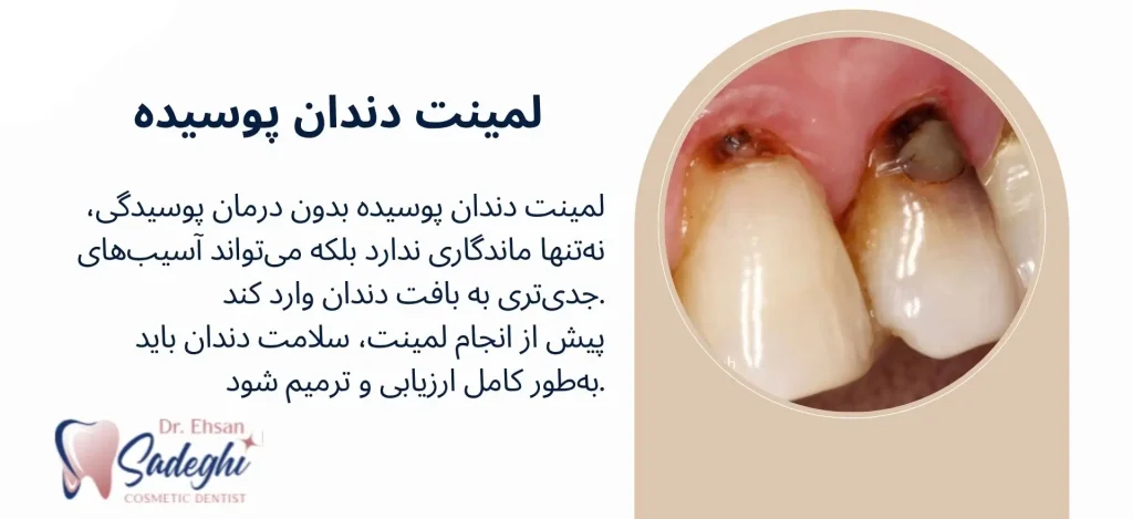 لمینت دندان پوسیده امکان پذیر است؟
