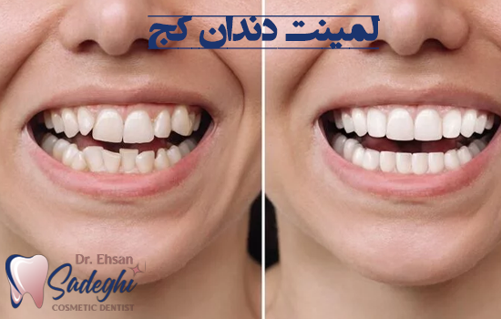 لمینت کردن دندان کج