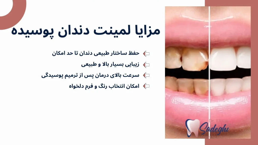 مزایا لمینت دندان پوسیده