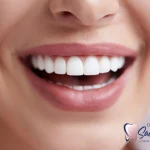 سن مناسب لمینت