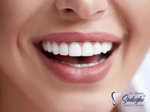 سن مناسب لمینت