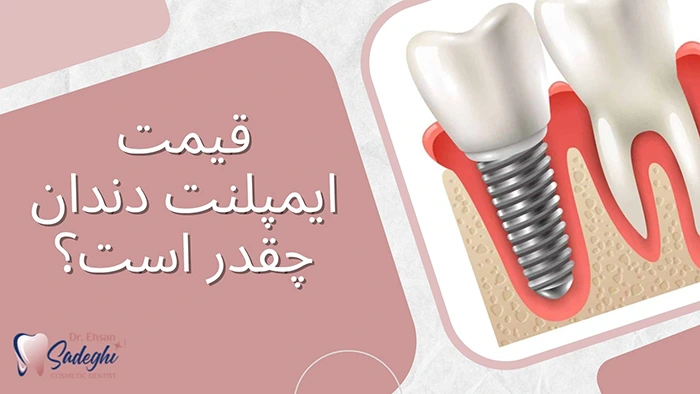 قیمت ایمپلنت دندان چقدر است؟