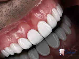 لمینت دندان شیشه ای