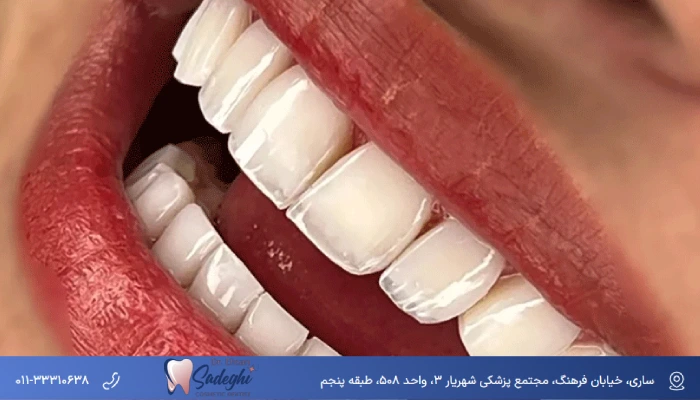 لمینت دندان شیشه ای توسط دکتر احسان صادقی