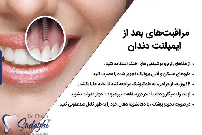 مراقبت های بعد از ایمپلنت دندان