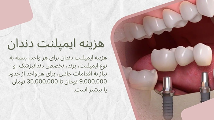 هزینه ایمپلنت دندان